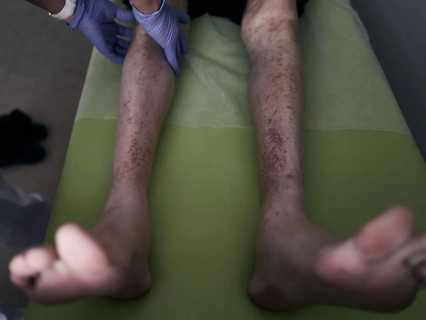 A Ukrainian soldier after Russian captivity.